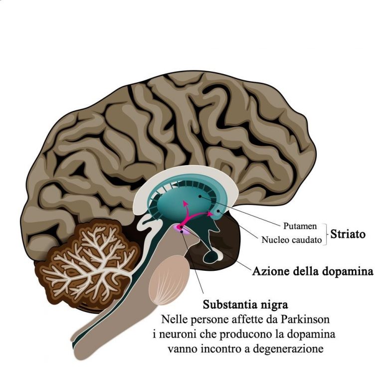 Perché Viene E Come Si Cura Il Parkinson I Primi Sintomi Cui Prestare ...